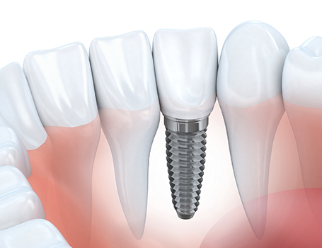 Dental Implants, Whitehorse Dentist